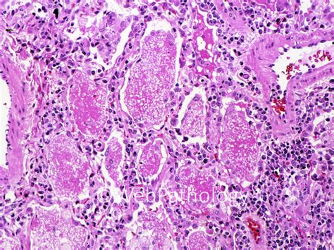 webpathology lung.